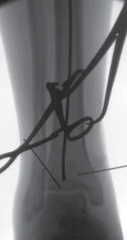 Illustration 37 for Optimal Nailing of the Tibia: Techniques for Challenging Fractures