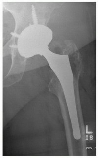 Illustration 32 for Uncemented Acetabular Revision: Optimizing Hemispherical Cup Use