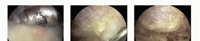 Illustration 7 for Find Relief: Arthroscopic Subacromial Decompression for Impingement