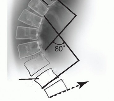 Illustration 6 for Adult Scoliosis: Uncover Causes & Find Lasting Back Pain Relief