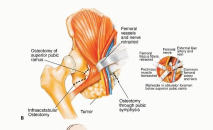 Illustration 37 for Surgical Pelvic Resection: Gluteus Maximus Muscle & Nerve Preservation