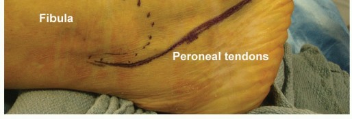 Illustration 8 for Lateral Column Lengthening: Relieve Flatfoot Pain & Correct Deformity
