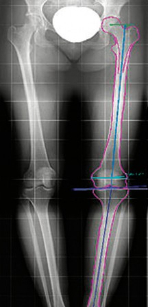 Illustration 5 for Templating for Primary THA: Optimize Outcomes & Avoid Pitfalls