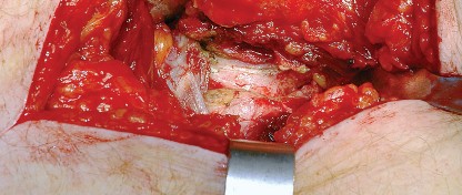 Illustration 26 for Unlock the Figure Posterior Approach to the Hip