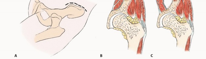 Illustration 22 for Pelvic Metastasis Surgery: A Component of the Utilitarian Approach