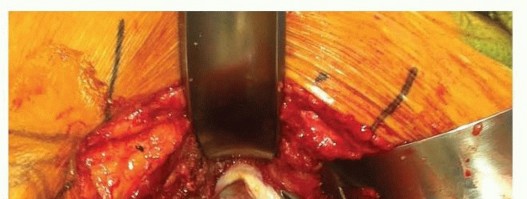 Illustration 12 for Total Hip Arthroplasty: Journey to Preventing Complications