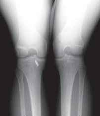 Illustration 5 for Successful Ligament Repair Revision: Fixing Failed ACLs