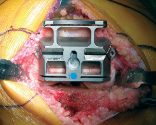 Illustration 19 for Minimally Invasive Subvastus: The Best Path to Quicker TKA Recovery