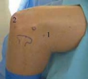 Illustration 3 for Unlock Relief: Arthroscopic Treatment of Epicondylitis Explained