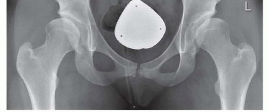 Illustration 13 for Hip Arthroscopy: Your Minimally Invasive Solution for Hip Pain