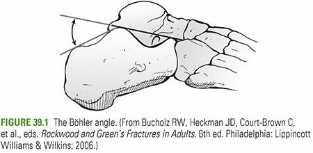 Illustration of calcaneus fractures calcaneus - Dr. Mohammed Hutaif
