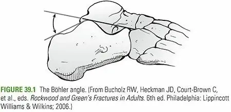كسر عظم الكعب (العقب): دليلك الشامل للتعافي واستعادة الحركة مع الأستاذ الدكتور محمد هطيف
