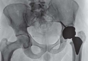 Illustration 38 for The Proxima: Why This Proximally Loading Implant Preserves Bone