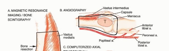 Illustration 25 for Understanding Benign Bone Tumors: Your Complete Preoperative Guide