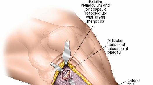 Illustration 13 for Surgical Access: Mastering the Tibia's Surface & Fibula Approaches