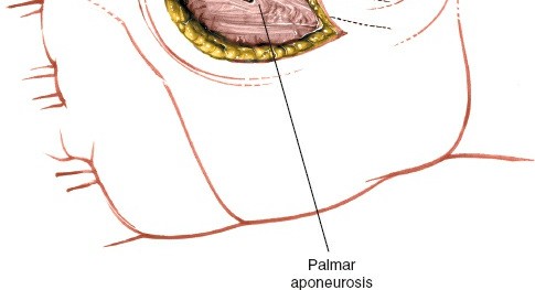 Illustration 233 for Essential Surgical Approaches: Uncover Every Aspect of the Wrist