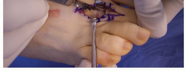 Illustration 23 for Hammer Toe Correction: Understanding the Extensor Digitorum Longus