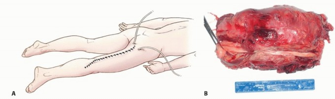 Illustration 24 for Posterior Thigh Resection: Rethinking Outcomes & Limb Sparing