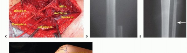 Illustration 32 for Beyond Amputation: The Type I Resection in Fibular Tumor Surgery