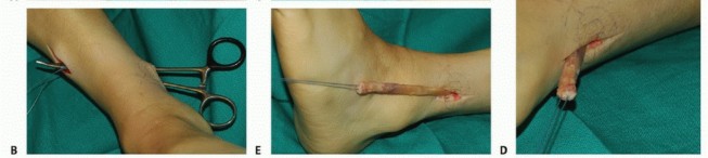 Illustration 12 for Foot Drop Surgery: How a Pin or Drill Elevates Tendon Transfer