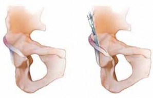 Illustration 26 for FAI: Impingement and Surgical Dislocation Explained