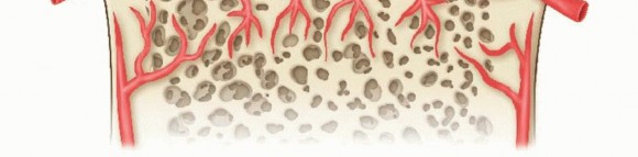 Illustration 11 for Dissecans of the Knee: What's the Difference – OCD vs. AVN?