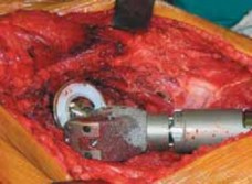 Illustration 36 for Advanced Arthroplasty for Malignant Lesions: Reclaim Your Mobility