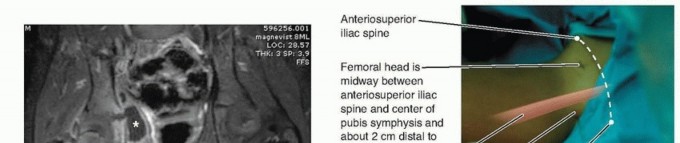 Illustration 6 for Septic Hip in Children: Mastering Anterior Drainage for Optimal Recovery
