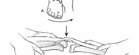 Illustration 14 for Master Pediatric Femoral Shaft & Knee Fractures: Interactive Module