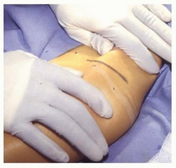 Illustration 8 for Labral Support Shelf Procedure: Preventing Perthes Deformity