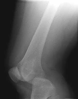 Illustration 163 for OrthoCash: Trauma MCQs & Cases for a yearold woman