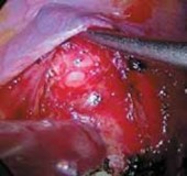 Illustration 17 for Mastering Anterior Interbody Arthrodesis with Instrumentation for Scoliosis