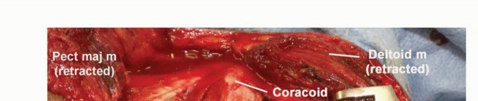 Illustration 23 for Limb-Sparing Resections Around the Shoulder: Optimizing Outcomes