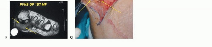 Illustration 18 for Treating Tumors of the Foot: Optimizing Amputation & Resection