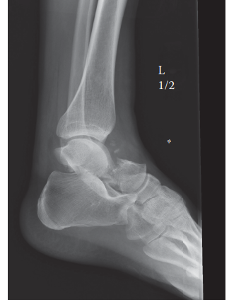 Complex Case Talus Fracture: Diagnosis & Management Revealed