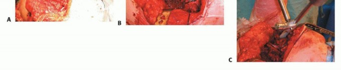 Illustration 12 for Hip Reimplantation Surgery: The Solution for Infected Implants