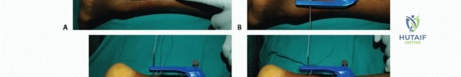 Anterior Cruciate Ligament (ACL) Rupture: Epidemiology, Anatomy & Surgical Management