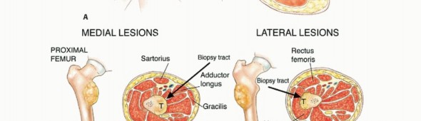 Illustration 34 for Precision Biopsy of Musculoskeletal Tumors for Accurate Diagnosis