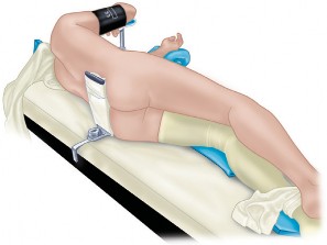 Illustration 28 for Mastering the Cementless Acetabular Cup: Techniques for Optimal Fixation