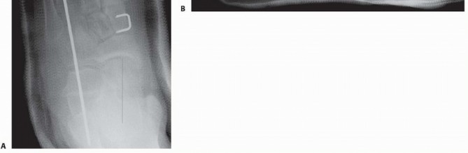 Illustration 23 for Calcaneal Lengthening Osteotomy: Correcting Hindfoot Valgus