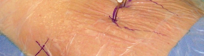 Illustration 17 for Essential Hip Arthroscopy Techniques for Optimal Outcomes