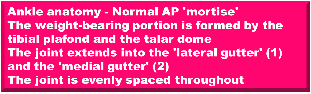 Illustration of medial malleolus fracture - Dr. Mohammed Hutaif