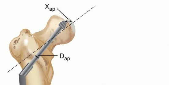 Illustration 21 for ORIF for Peritrochanteric Hip Fractures: Achieve Stable Mobility
