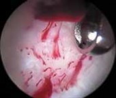 Illustration 37 for Solving Hip Soft Tissue Pathology with Advanced Arthroscopy