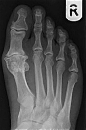 Hallux Rigidus Oral Questions: Your Expert Answer Guide