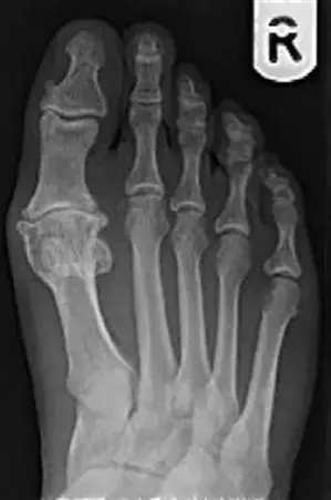 صورة توضيحية لـ خشونة إبهام القدم الكبير: دليل شامل للشفاء في صنعاء