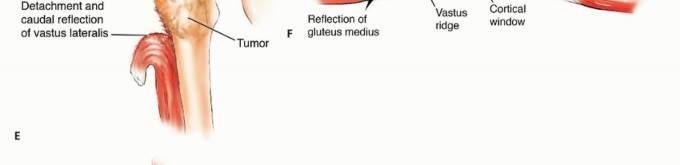 Illustration 11 for Mastering Femoral Metastases: Optimal Function for Femoris & Vastus