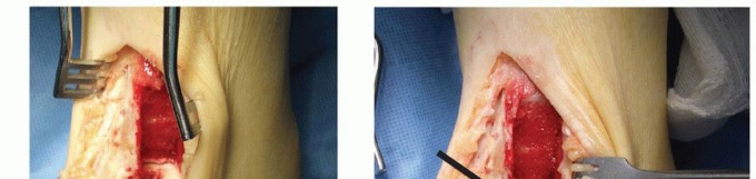 Illustration of osteotomy for osteochondral - Dr. Mohammed Hutaif