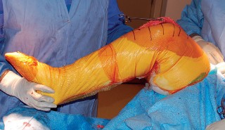 Illustration 51 for Mastering Gap Balancing in Revision TKA: Avoid Common Pitfalls