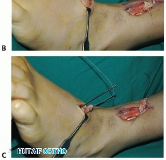 Illustration 55 for Restore Movement: Tendon Transfer for Common Peroneal Nerve Foot Drop